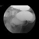 Polyp of rectum, diverticulosis: RF - Fluoroscopy