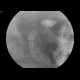 Bulbar ulcer: RF - Fluoroscopy