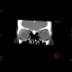 Pseudotumour of lacrimal gland: CT - Computed tomography