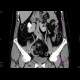 Ren arcuatus, horseshoe kidney: CT - Computed tomography