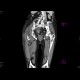 Necrotic tumor of rectosigmoid junction, fistulisation into thigh: CT - Computed tomography