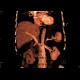 Splenic rupture: CT - Computed tomography