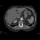 Separate branching of the hepatic and lienal artery from aorta: CT - Computed tomography