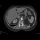 Separate branching of the hepatic and lienal artery from aorta: CT - Computed tomography