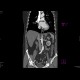 Separate branching of the hepatic and lienal artery from aorta: CT - Computed tomography