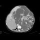 Abdominal sacroma: CT - Computed tomography