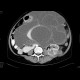 Abdominal sacroma: CT - Computed tomography
