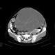 Abdominal sacroma: CT - Computed tomography