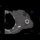 Sarcoma of shoulder: CT - Computed tomography