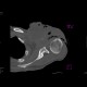 Sarcoma of shoulder: CT - Computed tomography
