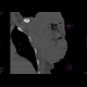 Sarcoma of shoulder: CT - Computed tomography
