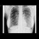 Septic emboli, lung: X-ray - Plain radiograph