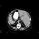 Situs viscerum inversus: CT - Computed tomography