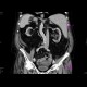 Situs viscerum inversus: CT - Computed tomography