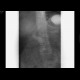 Duodenal stent, migration of stent: RF - Fluoroscopy