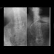 Duodenal stent, migration of stent: RF - Fluoroscopy