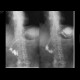 Duodenal stent, migration of stent: RF - Fluoroscopy
