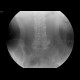 Duodenal stent, migration of stent: RF - Fluoroscopy