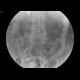 Duodenal stent, migration of stent: RF - Fluoroscopy