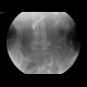 Duodenal stent, migration of stent: RF - Fluoroscopy