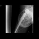Scrotal hernia, hip joint replacement: X-ray - Plain radiograph