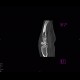 Fracture of scaphoid bone, perilunar subluxation: CT - Computed tomography