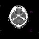 Subarachnoid hemorrhage: CT - Computed tomography