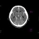Subarachnoid hemorrhage: CT - Computed tomography