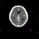 Subarachnoid hemorrhage: CT - Computed tomography