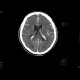 Subarachnoid hemorrhage: CT - Computed tomography