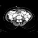 Inguinal hernia, small bowel ileus: CT - Computed tomography