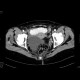 Inguinal hernia, small bowel ileus: CT - Computed tomography