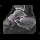 Fracture of calcaneus, comminuted: CT - Computed tomography