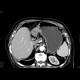 Carcinoma of stomach, antrum: CT - Computed tomography