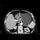 Carcinoma of stomach, antrum: CT - Computed tomography