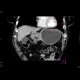 Carcinoma of stomach, antrum: CT - Computed tomography