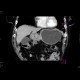 Carcinoma of stomach, antrum: CT - Computed tomography