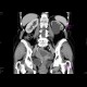 Tumour of the cervix of uterus, hydronephrosis: CT - Computed tomography