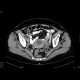 Tumour of the cervix of uterus, hydronephrosis: CT - Computed tomography