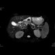 Adenocarcinoma of biliary duct: MRI - Magnetic Resonance Imaging