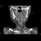 Carcinoma of the tongue: CT - Computed tomography