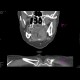 Carcinoma of the tongue: CT - Computed tomography