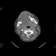Carcinoma of the tongue: CT - Computed tomography