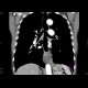 Carcinoma of oesophagus and cardia: CT - Computed tomography