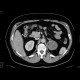 Tumour of the left adrenal gland, adenoma: CT - Computed tomography