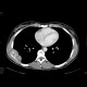 Rib tumour: CT - Computed tomography