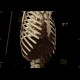 Rib tumour: CT - Computed tomography