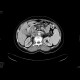 Carcinoma of gallblader: CT - Computed tomography