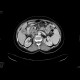 Carcinoma of gallblader: CT - Computed tomography