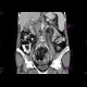 Carcinoma of gallblader: CT - Computed tomography